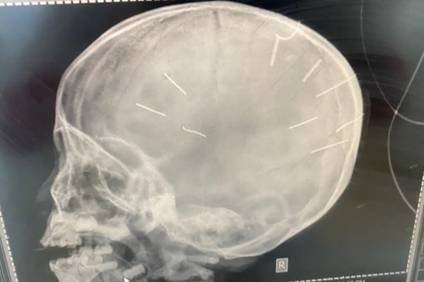 Bé gái 3 tuổi nghi bị hành hạ, Cơ quan điều tra sẽ khởi tố vụ án giết người?