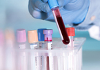 Xét nghiệm máu dự đoán khả năng sống của bệnh nhân Covid-19