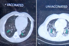 Hình ảnh chụp phổi thể hiện hiệu quả của vắc xin Covid-19