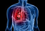 5 dấu hiệu sớm của ung thư phổi bạn cần biết
