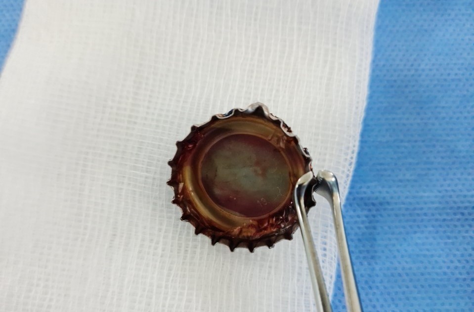 Thanh niên nuốt nắp chai sắc nhọn suốt một tháng mới nhớ ra