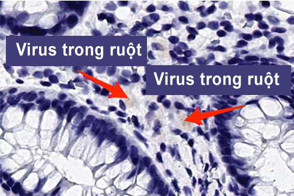 Cô bé 11 tuổi vẫn có virus nCoV trong ruột sau 3 tháng nhiễm bệnh