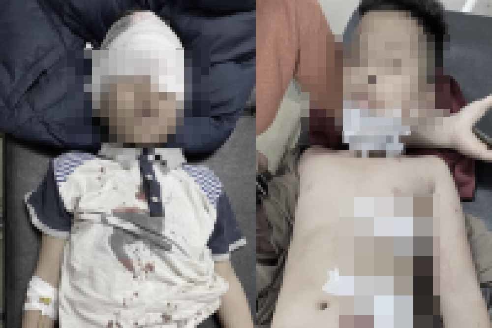 Nguyên nhân khó tin khiến bốn bé trai nguy kịch sau tiếng nổ ở Tuyên Quang