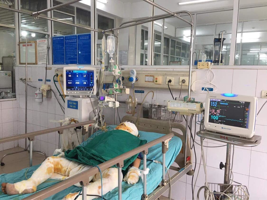 Hoả hoạn lúc cha đi vắng, 2 anh em mồ côi mẹ bị chết cháy và bỏng nặng