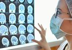 Bệnh nhân Covid-19 ít triệu chứng cũng có thể bị tổn thương não