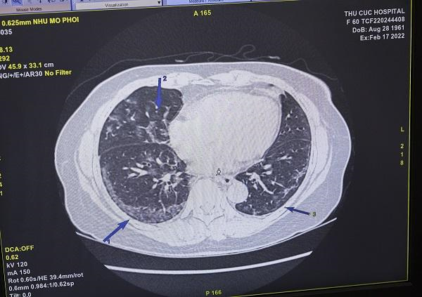 Hậu Covid-19: Tổn thương phổi khó lường phát hiện qua thăm khám