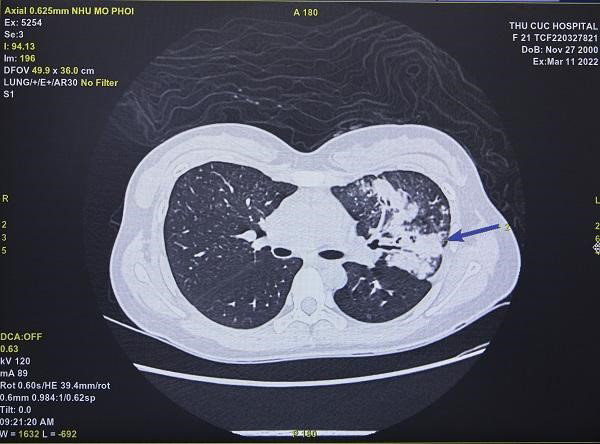 Post-Covid-19: Unpredictable lung damage detected through examination