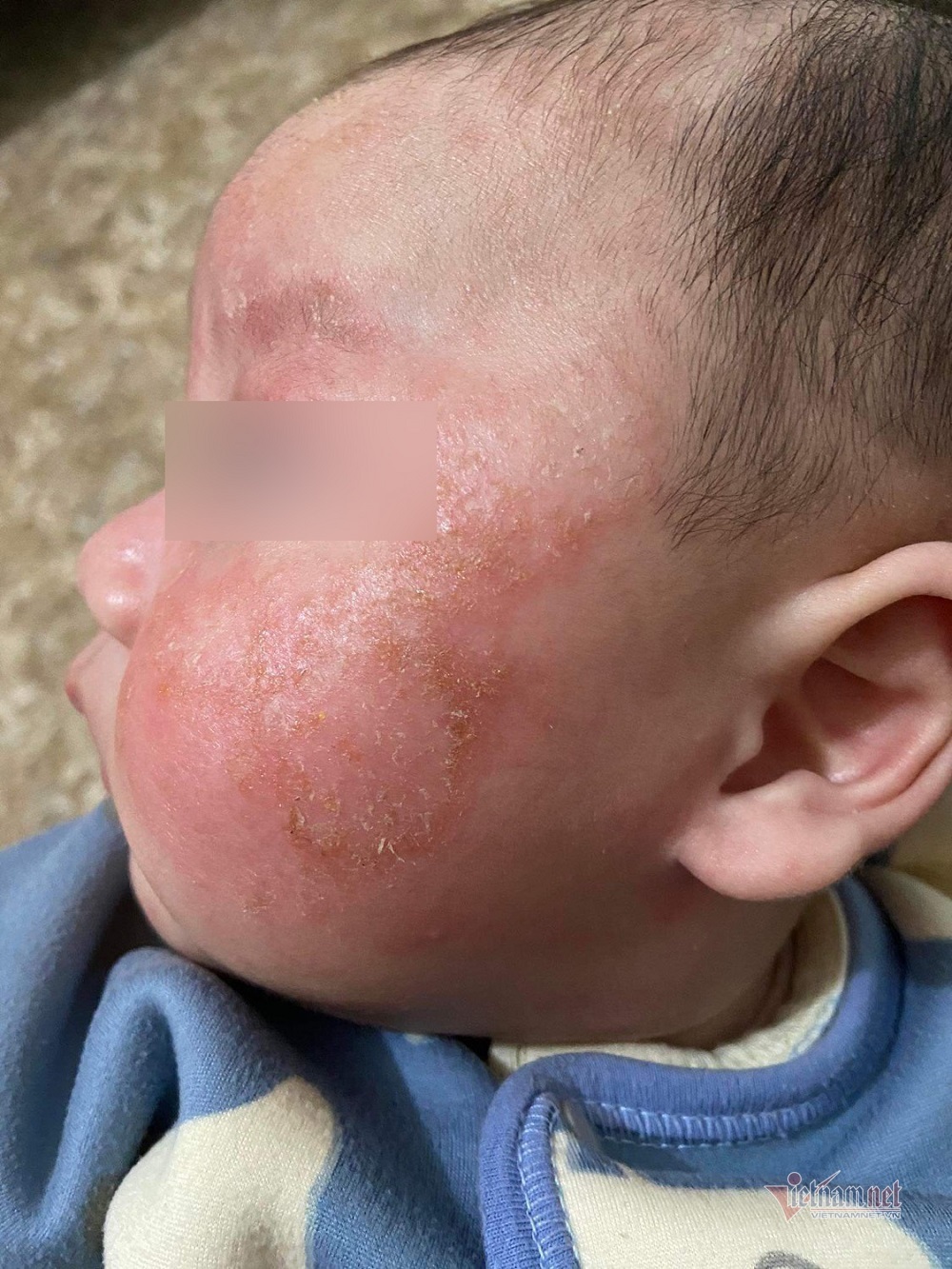 Abstain from bathing for 6 days when infected with Covid-19, young skin is scaly, red