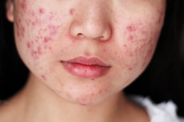 Acne, dark skin after recovering from Covid-19 is worrisome?