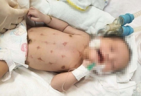 Newborn baby is in critical condition after being warmed by a charcoal bath