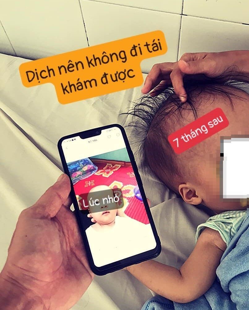 Cậu bé 4 tháng tuổi làm con nuôi bệnh viện vì mang chiếc đầu 'bự'