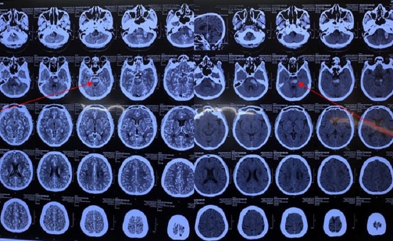 One month of efforts to save a Covid-19 patient with a critical stroke