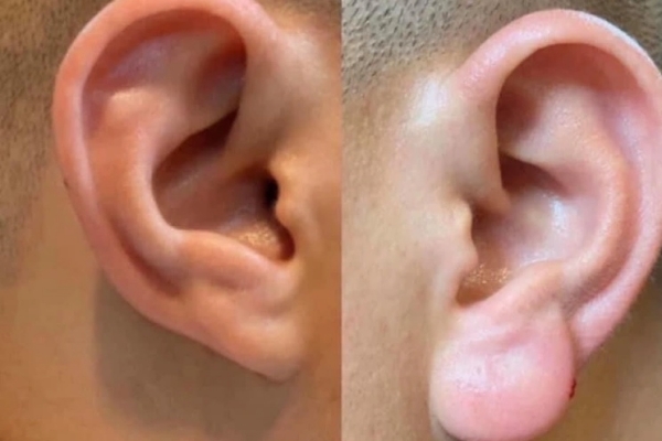Tiêm filler tai phật có tác dụng gì?
