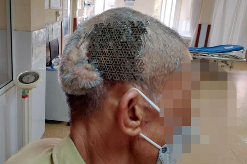 Người đàn ông nhập viện với miếng Titanium lộ trên đầu
