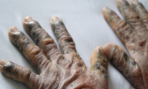 Uống thuốc tăng cường sinh lý, người đàn ông bị bong tróc toàn thân